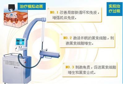 杭州308准分子激光诊疗多久做一次?多久才能见效呢